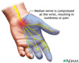 carpal-tunnel-syndrome